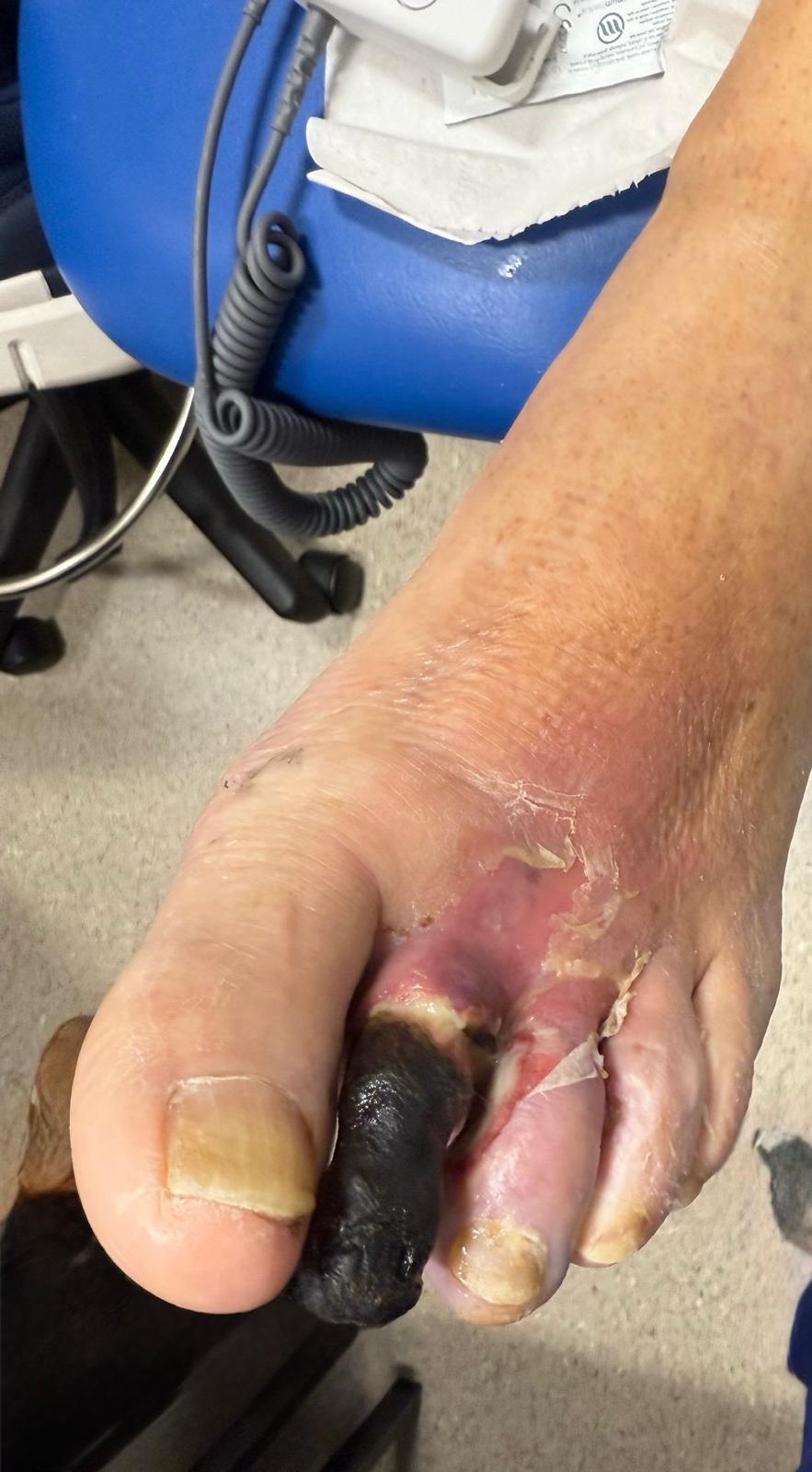 Peripheral arterial Disease