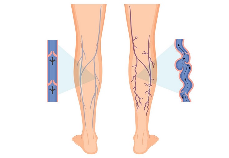 Varicose Vein